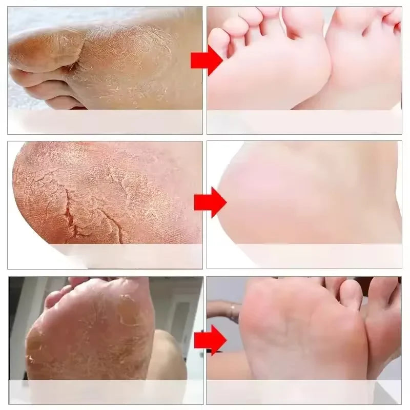 Herbal Anti Crack Foot Cream