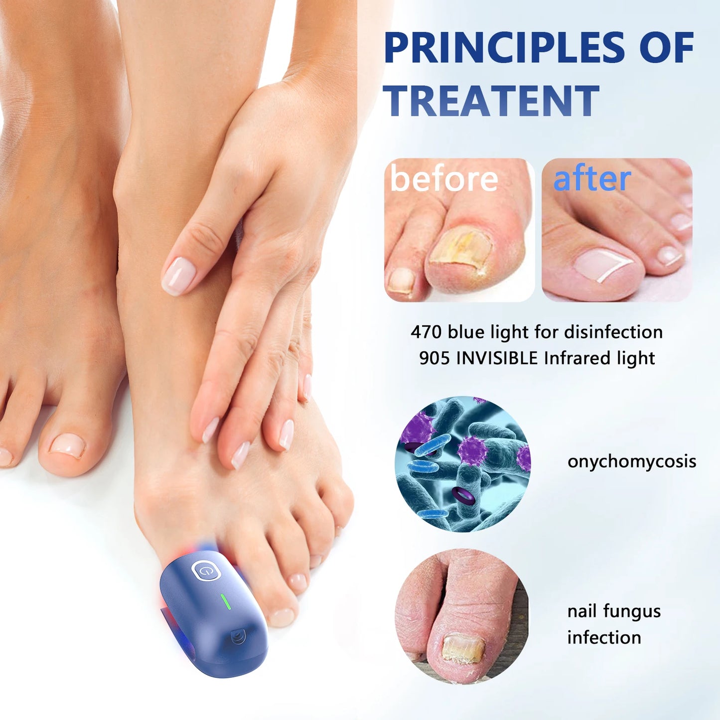 KTS Nail Fungus Cleaning Device
