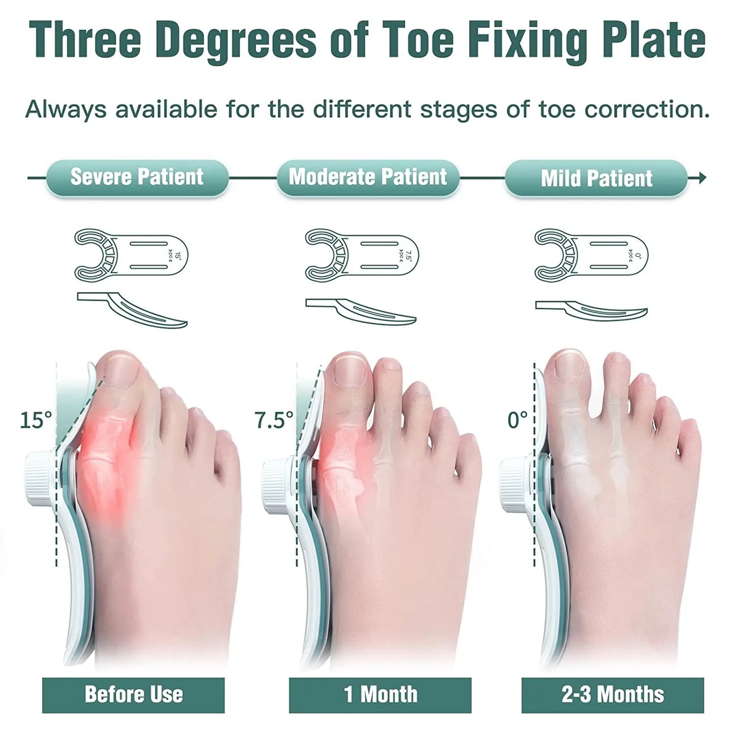 Foot Care Bunion Corrector Orthopedic Bunion Splint