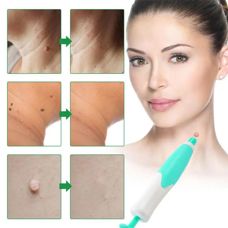 Skin Tag Removal Kit Easy And Painless