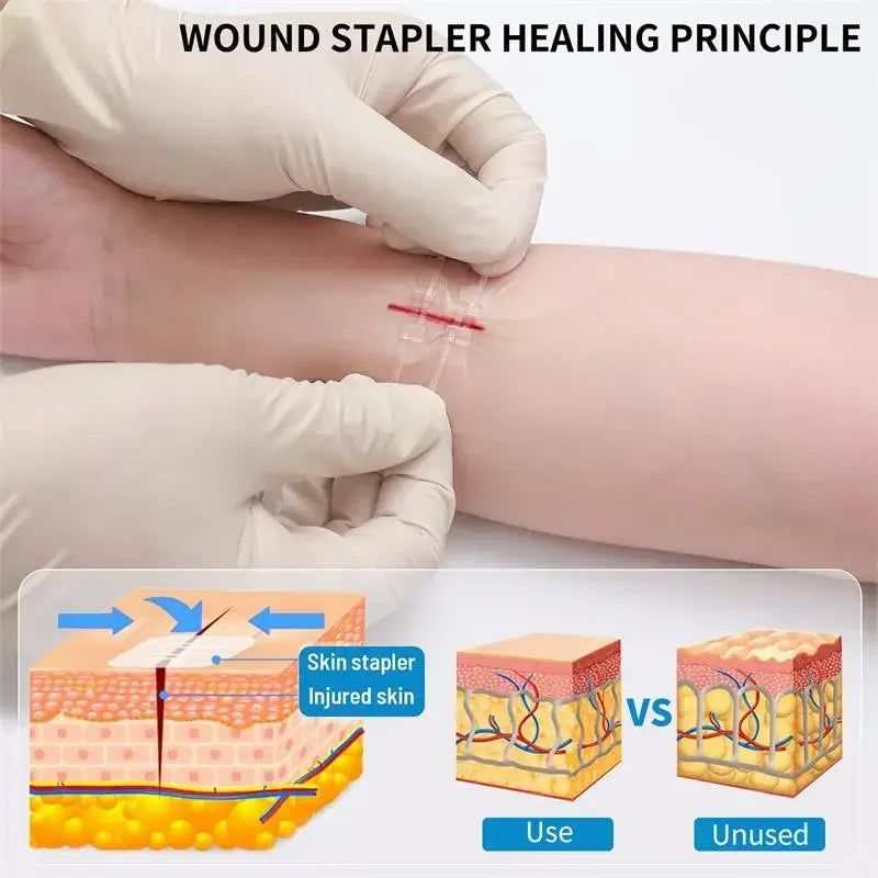 Zipper Band-Aid Wound Closure Device