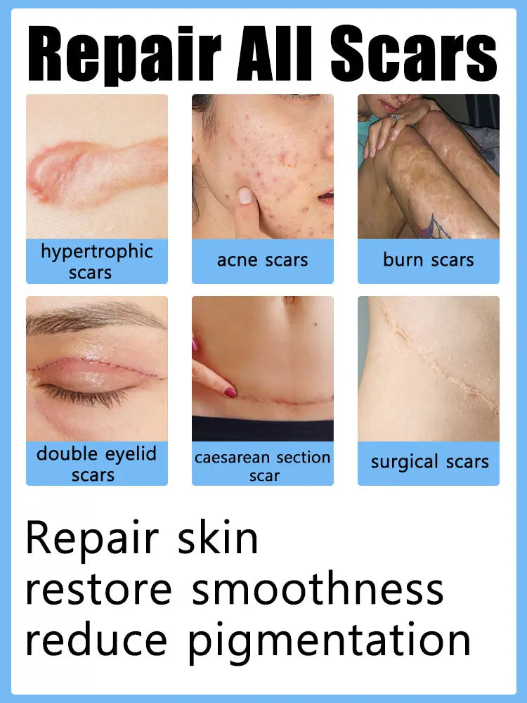 Blue Light Pen Painless Laser Removes Scars Acne
