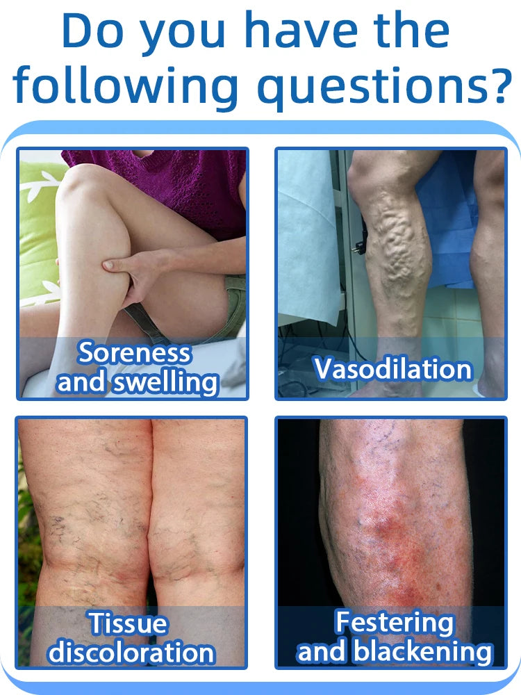Laser leg vein repair
