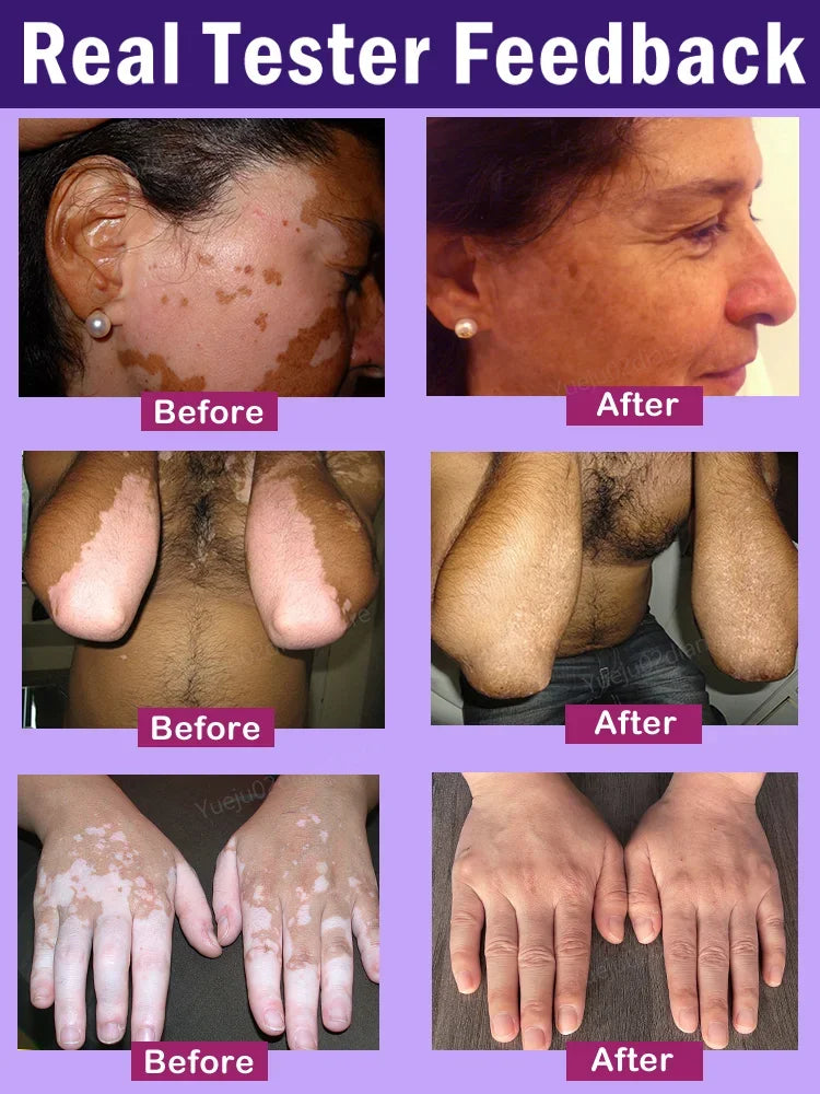 Vitiligo Ointment Effectively Improve White Spot Skin Eliminate