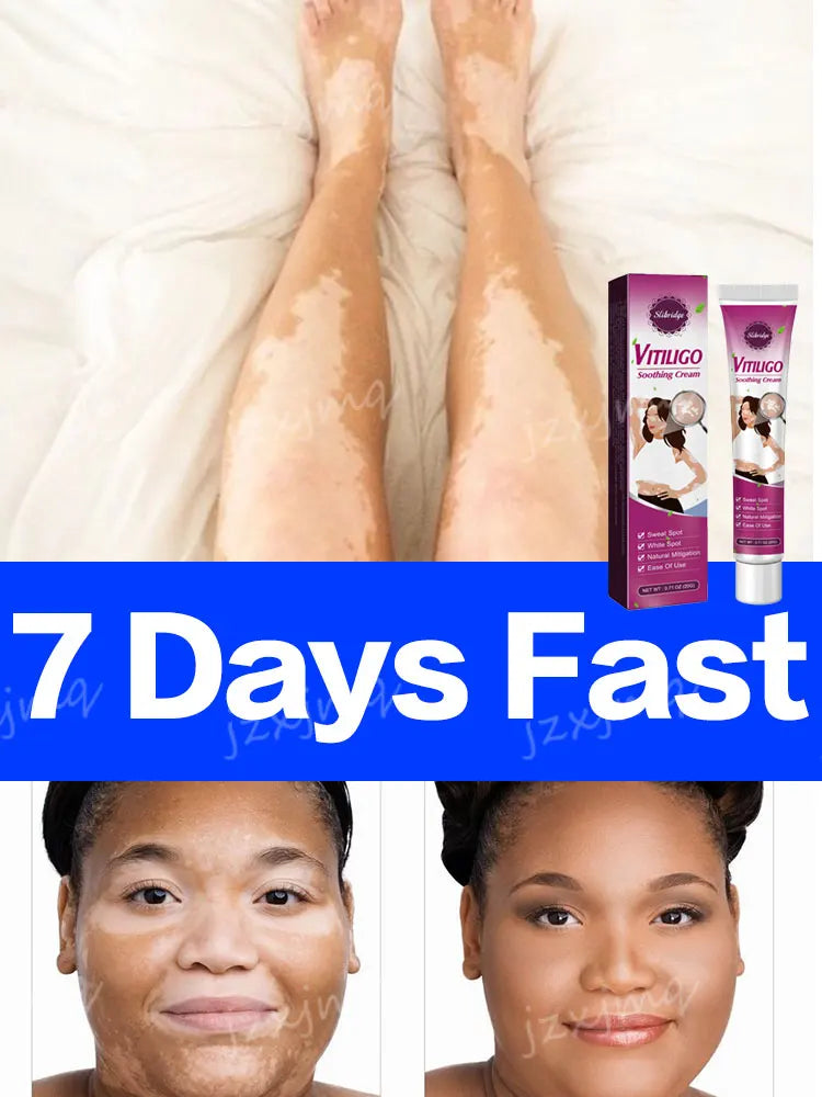 Vitiligo Ointment Effectively Improve White Spot Skin Eliminate