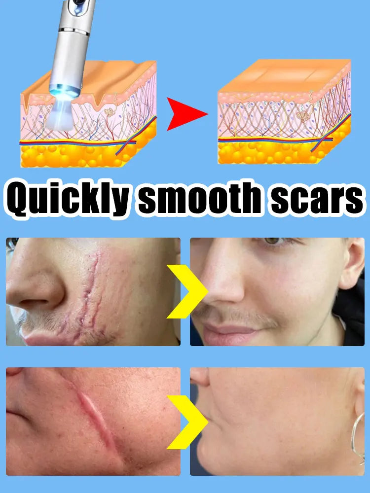 Blue Light Pen Painless Laser Removes Scars Acne
